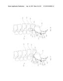 ADJUSTABLE SPINAL IMPLANT diagram and image