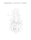 ADJUSTABLE SPINAL IMPLANT diagram and image