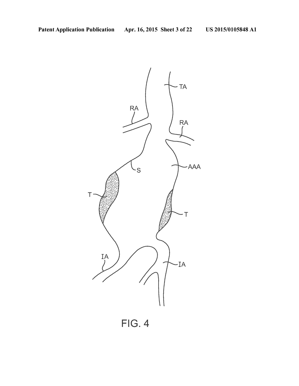 GRAFT SYSTEMS HAVING FILLING STRUCTURES SUPPORTED BY SCAFFOLDS AND METHODS     FOR THEIR USE - diagram, schematic, and image 04