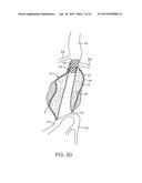 GRAFT SYSTEMS HAVING FILLING STRUCTURES SUPPORTED BY SCAFFOLDS AND METHODS     FOR THEIR USE diagram and image