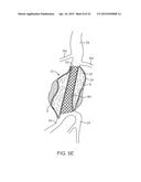 GRAFT SYSTEMS HAVING FILLING STRUCTURES SUPPORTED BY SCAFFOLDS AND METHODS     FOR THEIR USE diagram and image