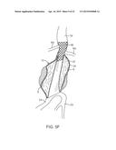 GRAFT SYSTEMS HAVING FILLING STRUCTURES SUPPORTED BY SCAFFOLDS AND METHODS     FOR THEIR USE diagram and image