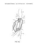 GRAFT SYSTEMS HAVING FILLING STRUCTURES SUPPORTED BY SCAFFOLDS AND METHODS     FOR THEIR USE diagram and image