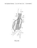 GRAFT SYSTEMS HAVING FILLING STRUCTURES SUPPORTED BY SCAFFOLDS AND METHODS     FOR THEIR USE diagram and image