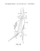 GRAFT SYSTEMS HAVING FILLING STRUCTURES SUPPORTED BY SCAFFOLDS AND METHODS     FOR THEIR USE diagram and image