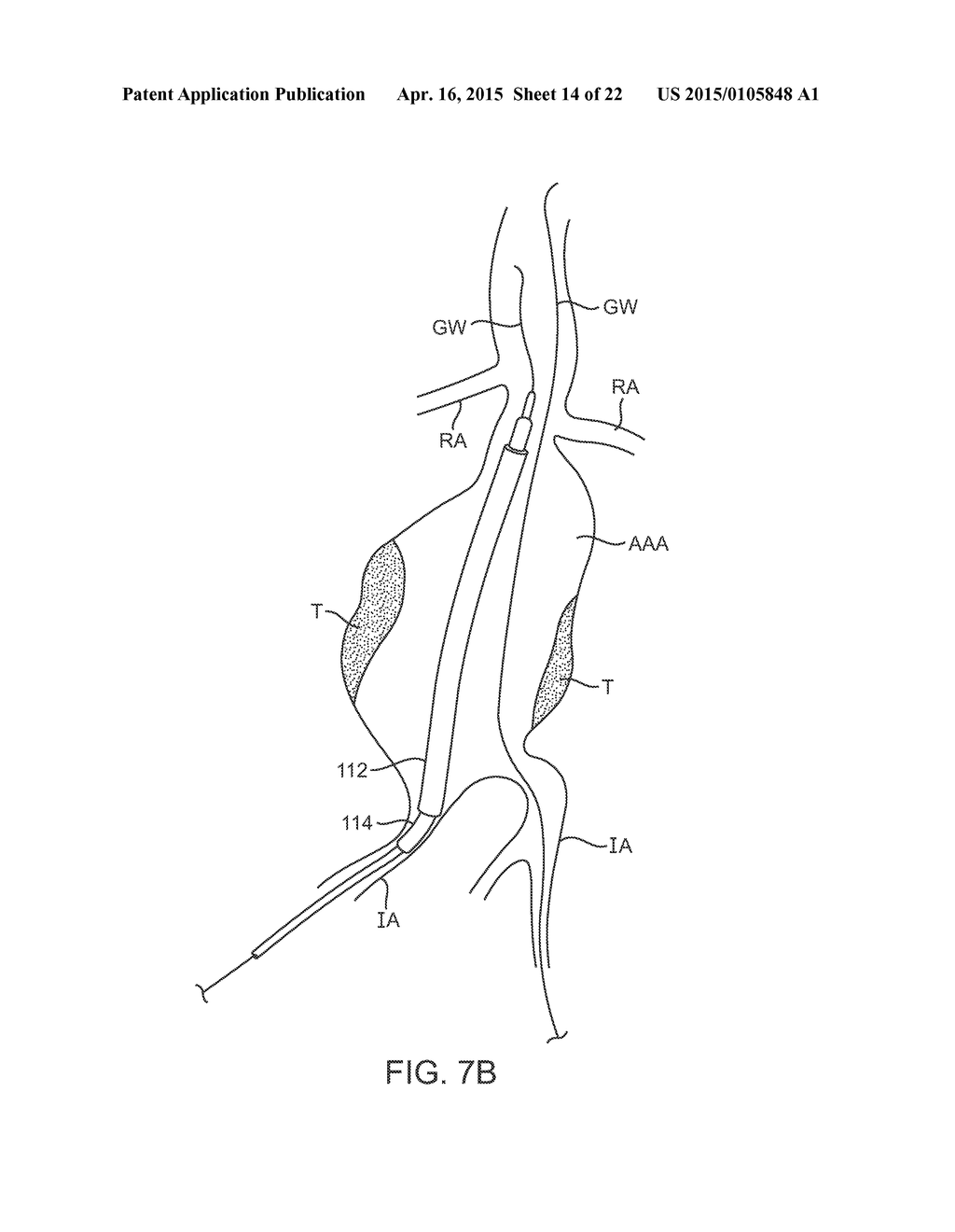 GRAFT SYSTEMS HAVING FILLING STRUCTURES SUPPORTED BY SCAFFOLDS AND METHODS     FOR THEIR USE - diagram, schematic, and image 15