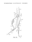 GRAFT SYSTEMS HAVING FILLING STRUCTURES SUPPORTED BY SCAFFOLDS AND METHODS     FOR THEIR USE diagram and image