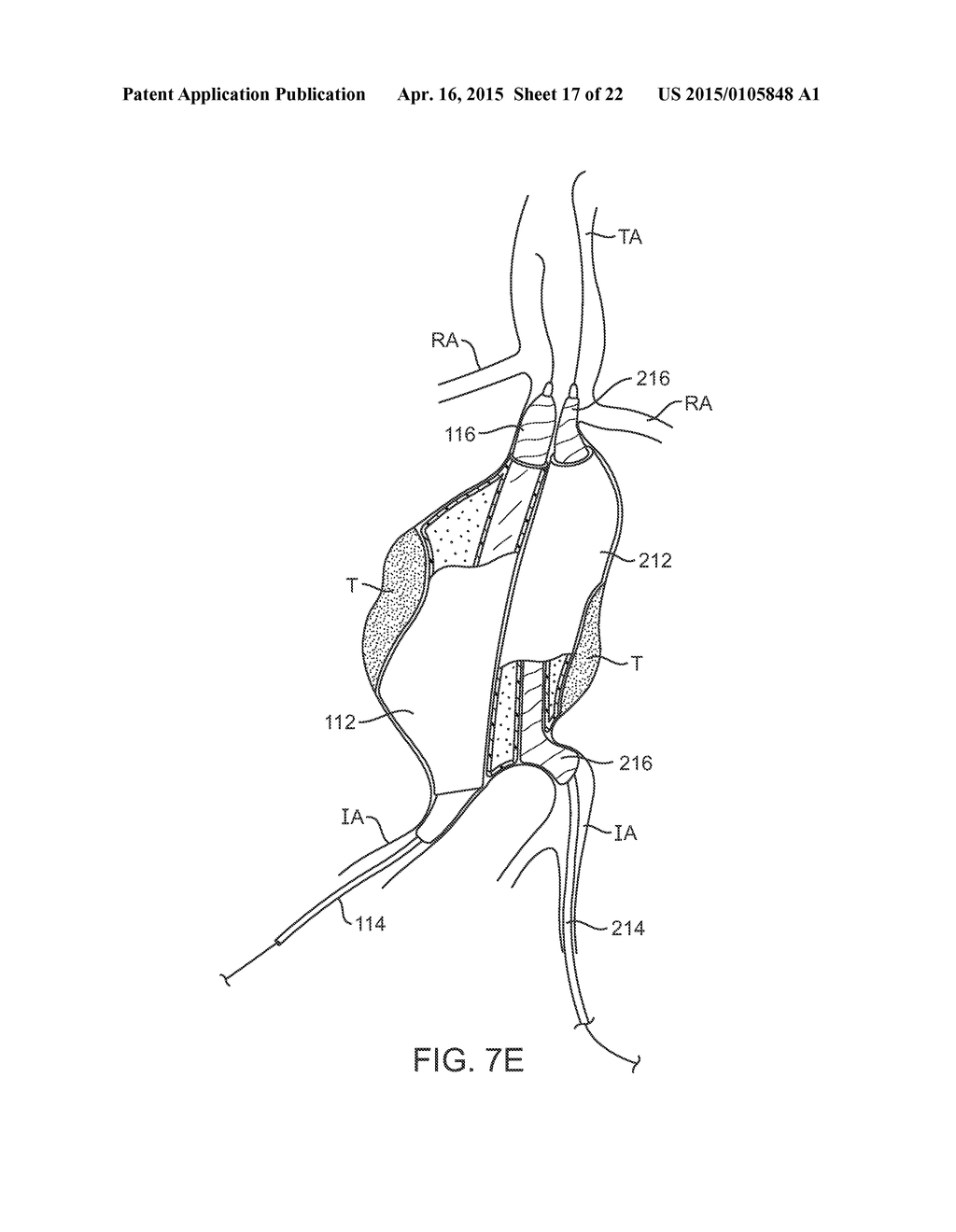 GRAFT SYSTEMS HAVING FILLING STRUCTURES SUPPORTED BY SCAFFOLDS AND METHODS     FOR THEIR USE - diagram, schematic, and image 18