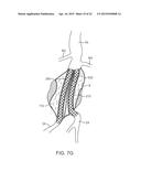 GRAFT SYSTEMS HAVING FILLING STRUCTURES SUPPORTED BY SCAFFOLDS AND METHODS     FOR THEIR USE diagram and image