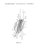 GRAFT SYSTEMS HAVING FILLING STRUCTURES SUPPORTED BY SCAFFOLDS AND METHODS     FOR THEIR USE diagram and image