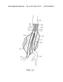 GRAFT SYSTEMS HAVING FILLING STRUCTURES SUPPORTED BY SCAFFOLDS AND METHODS     FOR THEIR USE diagram and image