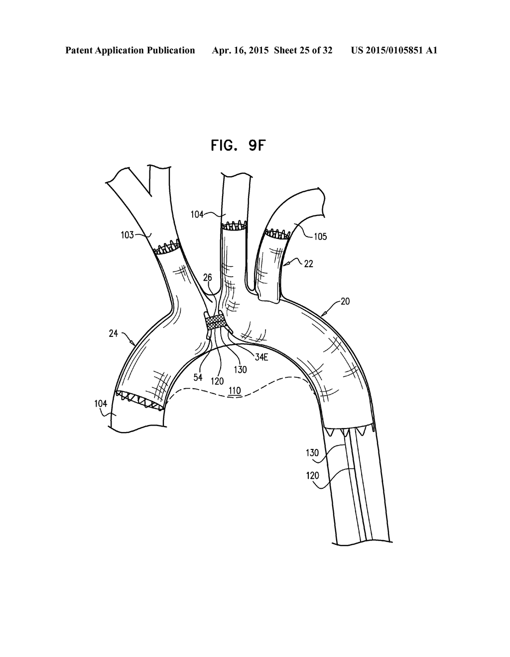 MULTI-COMPONENT STENT-GRAFT SYSTEM FOR IMPLANTATION IN A BLOOD VESSEL WITH     MULTIPLE BRANCHES - diagram, schematic, and image 26