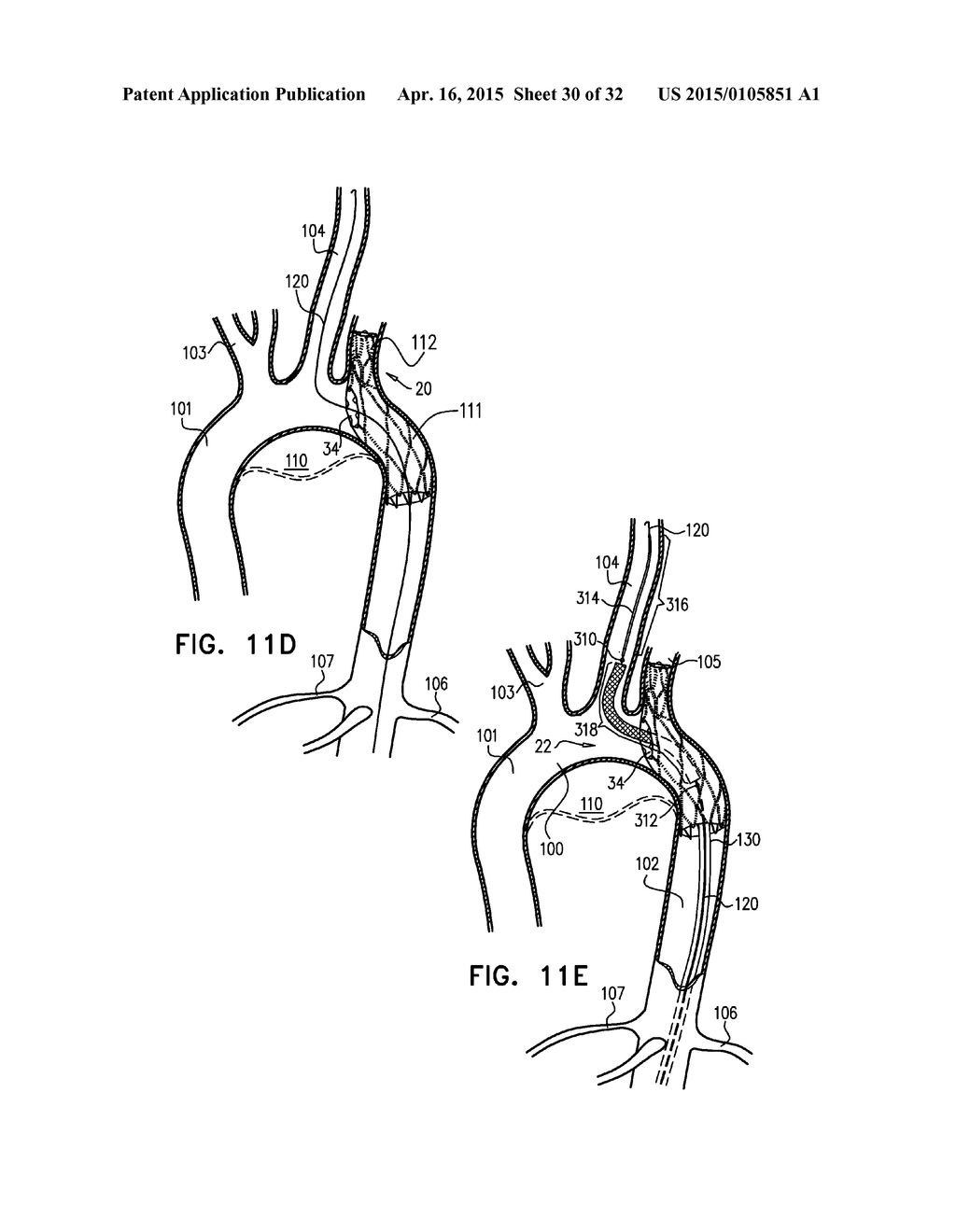 MULTI-COMPONENT STENT-GRAFT SYSTEM FOR IMPLANTATION IN A BLOOD VESSEL WITH     MULTIPLE BRANCHES - diagram, schematic, and image 31