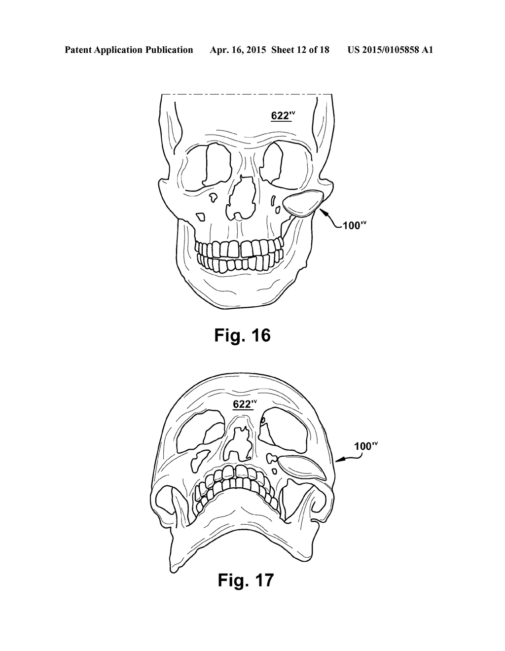 PROSTHETIC IMPLANTS - diagram, schematic, and image 13