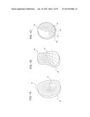 METHODS AND DEVICES FOR LESS INVASIVE GLENOID REPLACEMENT diagram and image