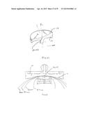 METHODS AND DEVICES FOR LESS INVASIVE GLENOID REPLACEMENT diagram and image