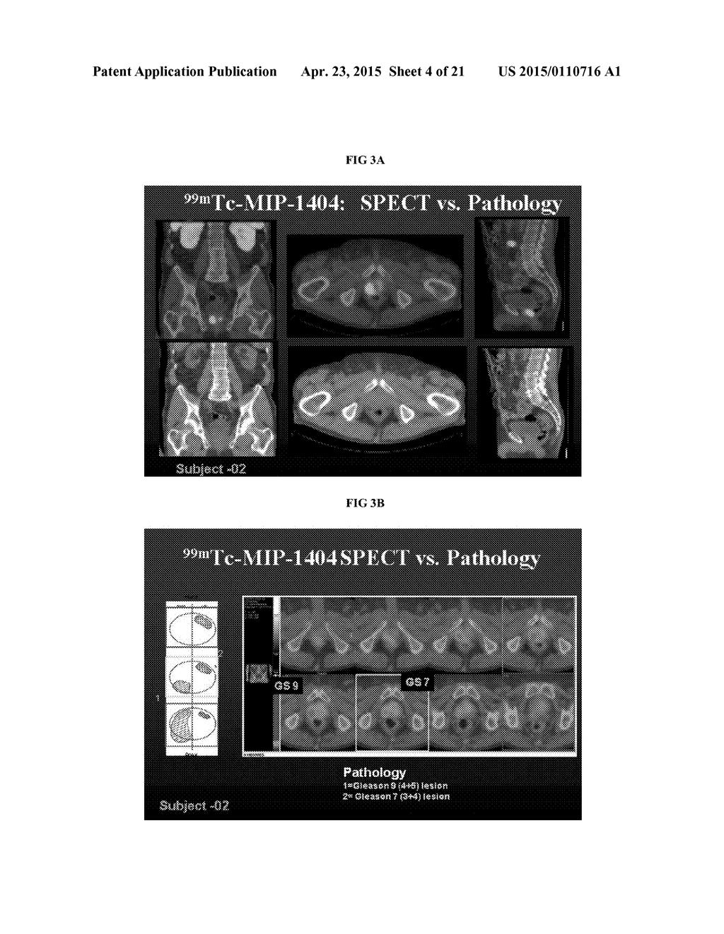 METHODS OF USING SPECT/CT ANALYSIS FOR STAGING CANCER - diagram, schematic, and image 05