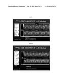 METHODS OF USING SPECT/CT ANALYSIS FOR STAGING CANCER diagram and image