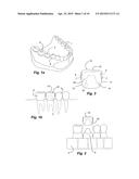 METHOD OF MAKING A DENTAL RESTORATION THAT INHIBITS TOOTH DEMINERALIZATION diagram and image