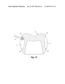 METHOD OF MAKING A DENTAL RESTORATION THAT INHIBITS TOOTH DEMINERALIZATION diagram and image