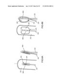 SYSTEMS AND METHODS FOR MONITORING ENDOLUMINAL VALVE FORMATION diagram and image