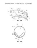 SYSTEMS AND METHODS FOR MONITORING ENDOLUMINAL VALVE FORMATION diagram and image