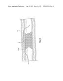 APPARATUS HAVING A SELECTIVELY CURVED DISTAL END AND METHODS FOR USE diagram and image