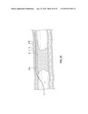 APPARATUS HAVING A SELECTIVELY CURVED DISTAL END AND METHODS FOR USE diagram and image