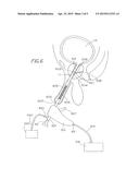 Method for Treating a Tubular Anatomical Structure diagram and image