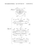 Method for Treating a Tubular Anatomical Structure diagram and image