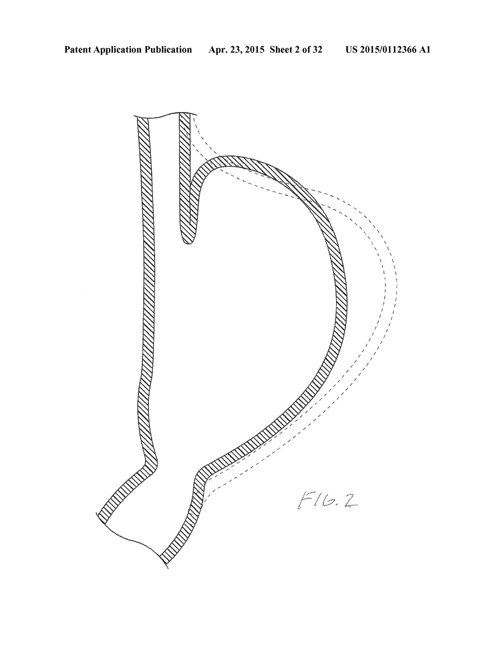 METHODS AND DEVICES FOR MANIPULATING AND FASTENING TISSUE - diagram, schematic, and image 03