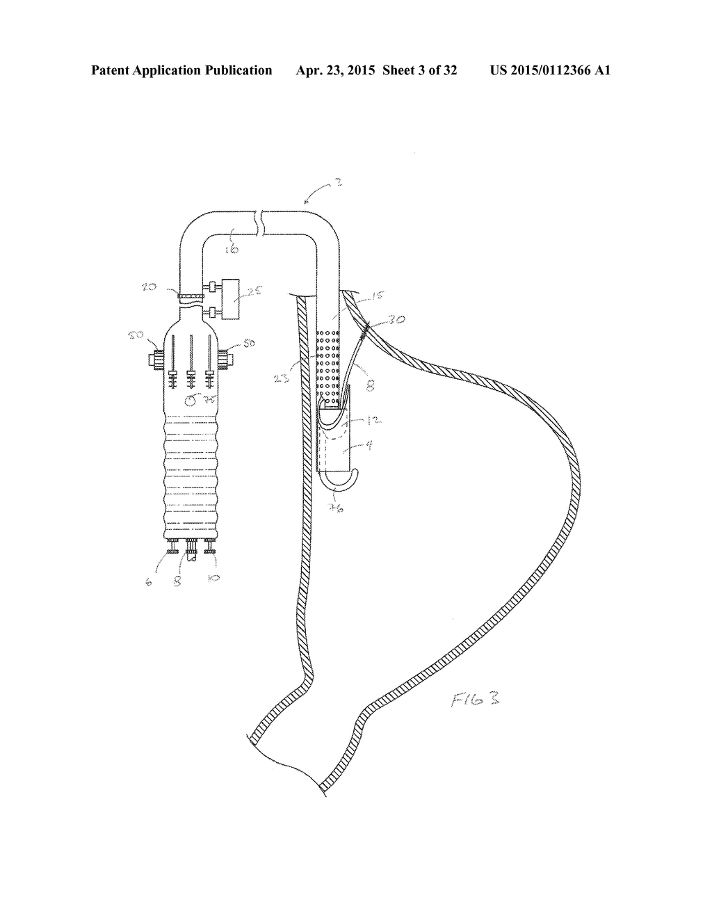 METHODS AND DEVICES FOR MANIPULATING AND FASTENING TISSUE - diagram, schematic, and image 04