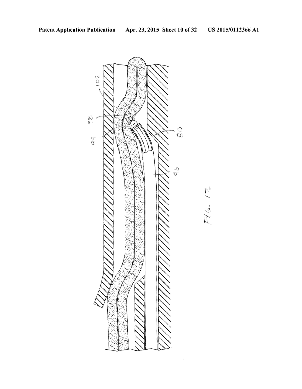 METHODS AND DEVICES FOR MANIPULATING AND FASTENING TISSUE - diagram, schematic, and image 11