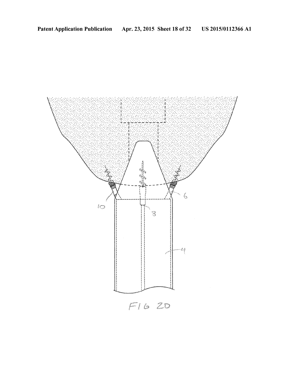 METHODS AND DEVICES FOR MANIPULATING AND FASTENING TISSUE - diagram, schematic, and image 19