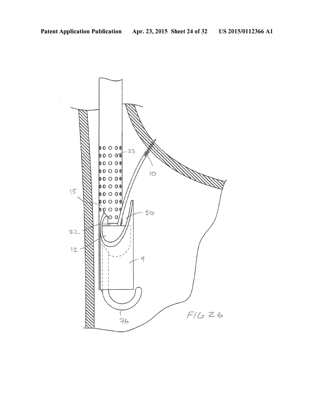 METHODS AND DEVICES FOR MANIPULATING AND FASTENING TISSUE - diagram, schematic, and image 25