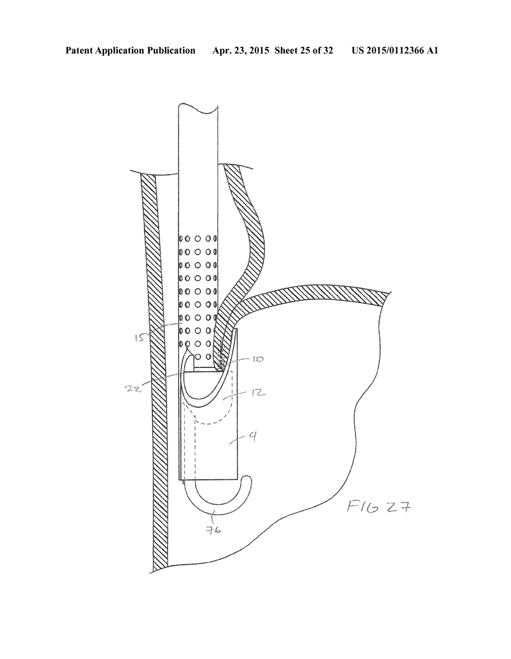 METHODS AND DEVICES FOR MANIPULATING AND FASTENING TISSUE - diagram, schematic, and image 26