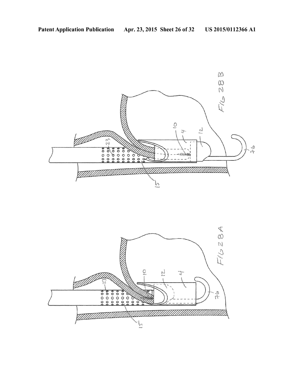 METHODS AND DEVICES FOR MANIPULATING AND FASTENING TISSUE - diagram, schematic, and image 27