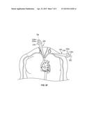 TRANSCATHETER VALVE IMPLANTATION ACCESS SHEATHS diagram and image