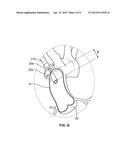 TRANSCATHETER VALVE IMPLANTATION ACCESS SHEATHS diagram and image