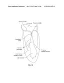 COAPTATION ENHANCEMENT IMPLANT, SYSTEM, AND METHOD diagram and image