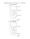 COAPTATION ENHANCEMENT IMPLANT, SYSTEM, AND METHOD diagram and image