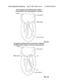 COAPTATION ENHANCEMENT IMPLANT, SYSTEM, AND METHOD diagram and image