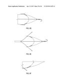 COAPTATION ENHANCEMENT IMPLANT, SYSTEM, AND METHOD diagram and image