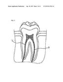 AUTOMATIC ROOT-CANAL TREATMENT-MATERIAL ARRANGEMENT AND SUPPLY DEVICE, AND     ROOT-CANAL TREATMENT-MATERIAL PACKAGING SYSTEM COMPRISING SAME diagram and image