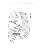 CIRCULAR SURGICAL STAPLING DEVICE INCLUDING BUTTRESS MATERIAL diagram and image