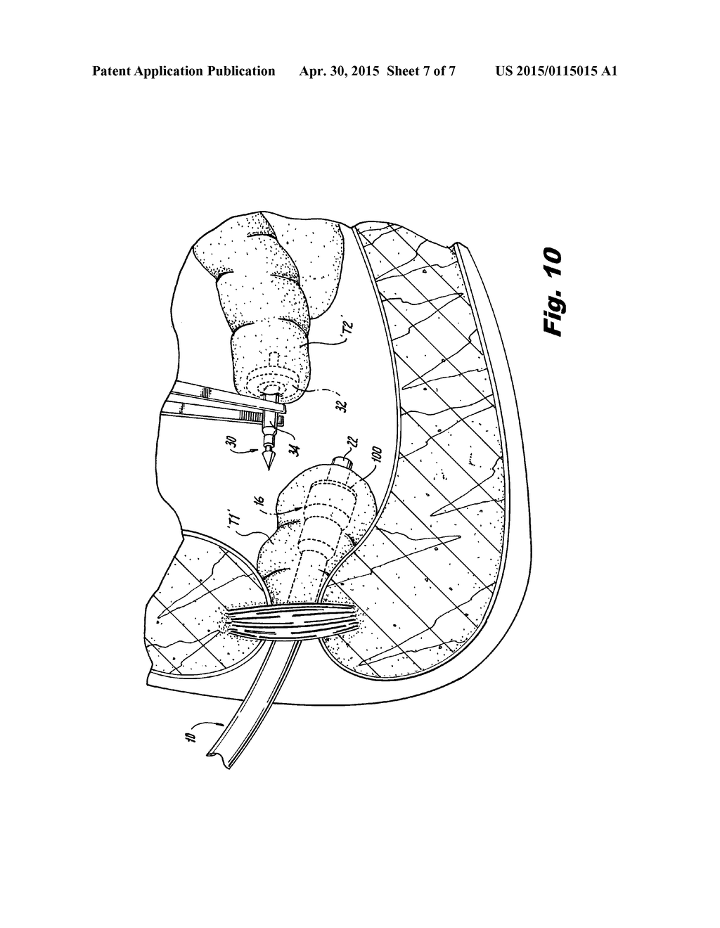 CIRCULAR SURGICAL STAPLING DEVICE INCLUDING BUTTRESS MATERIAL - diagram, schematic, and image 08