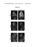 INHIBITION OF COLONY STIMULATING FACTOR-1 RECEPTOR SIGNALING FOR THE     TREATMENT OF BRAIN CANCER diagram and image