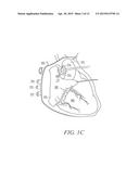 IMPLANTABLE SYSTEM TO TRANSVASCULARLY STIMULATE NERVE diagram and image