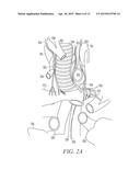 IMPLANTABLE SYSTEM TO TRANSVASCULARLY STIMULATE NERVE diagram and image