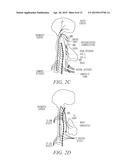 IMPLANTABLE SYSTEM TO TRANSVASCULARLY STIMULATE NERVE diagram and image